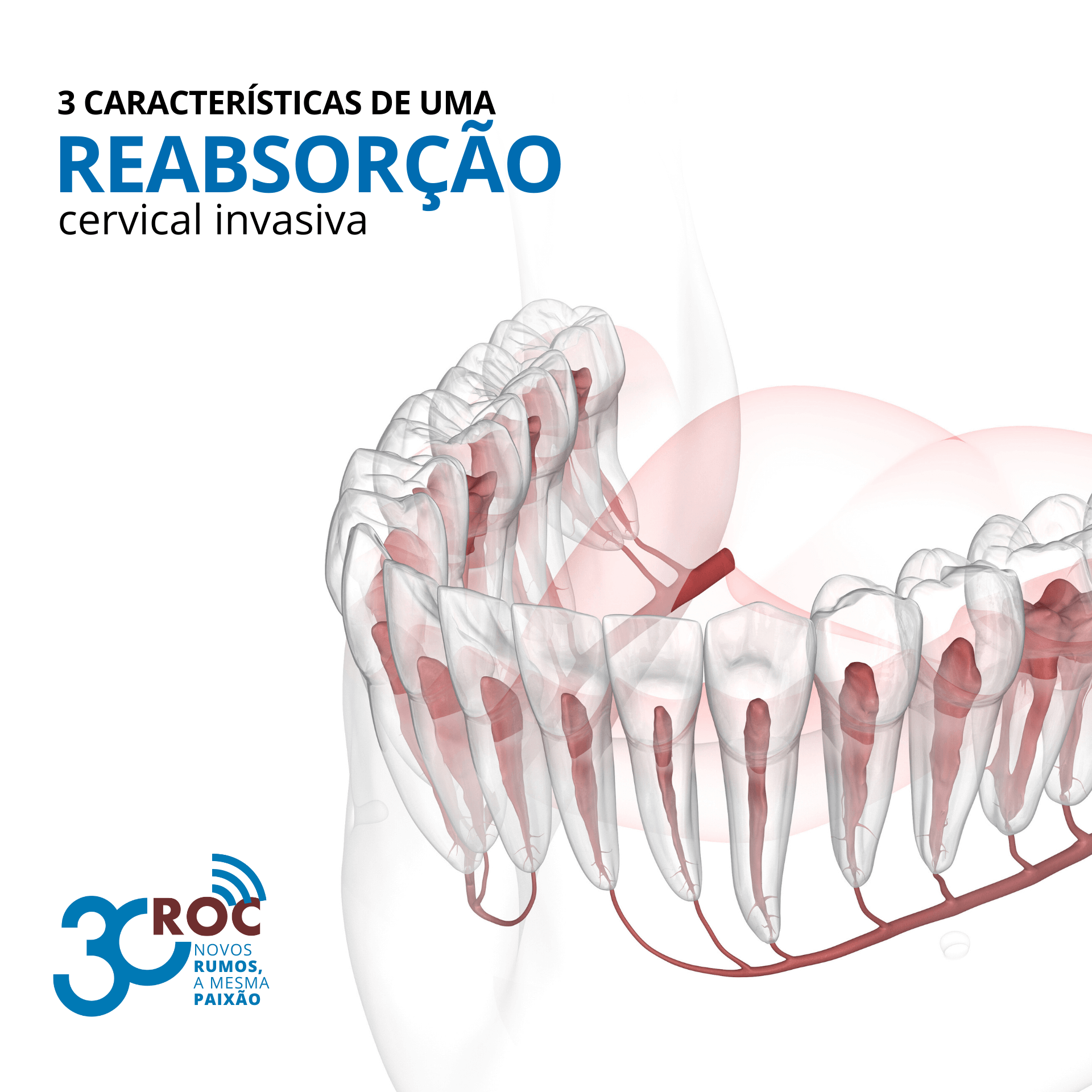 3 caracterÃ­sticas de uma reabsorÃ§Ã£o cervical invasiva