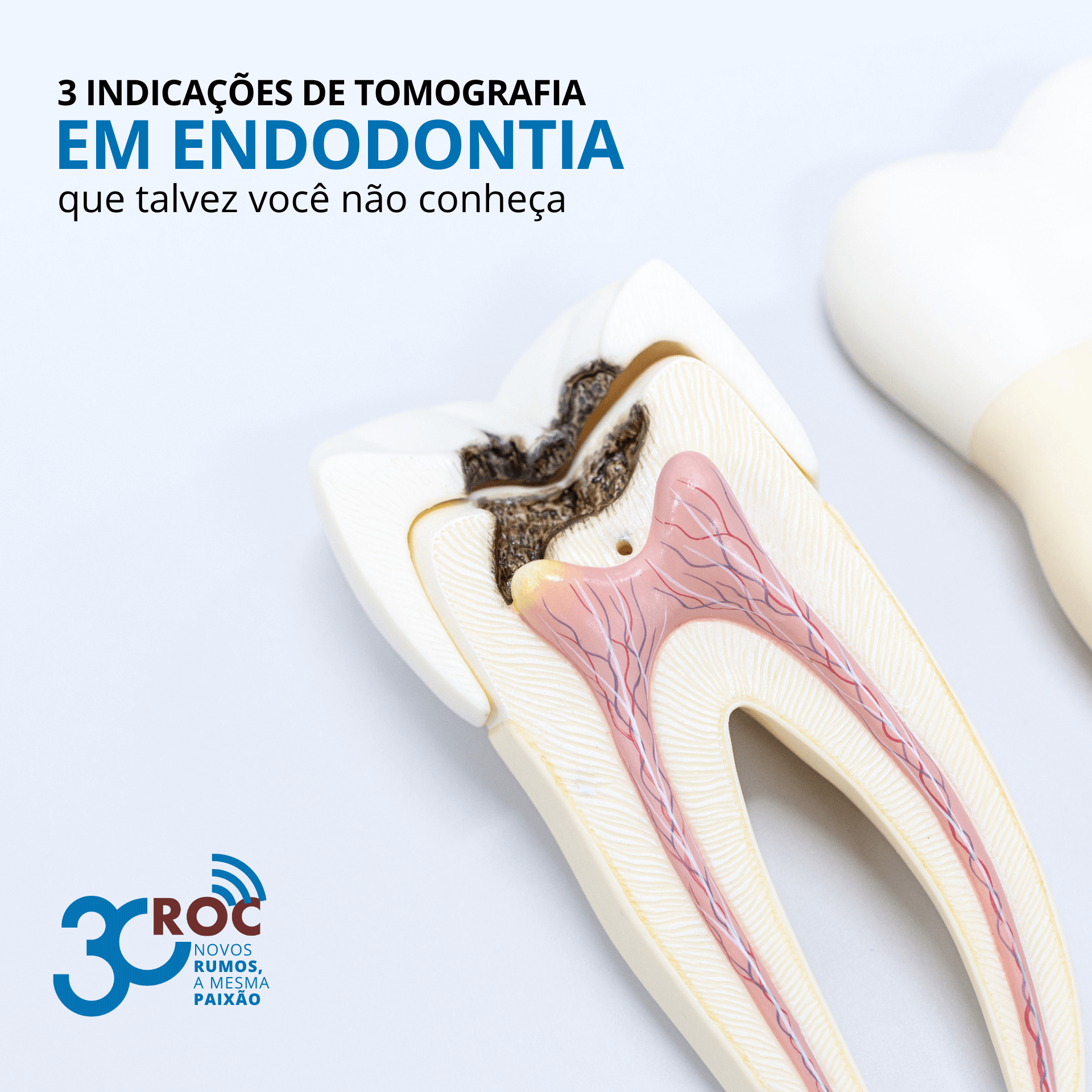 3 indicaÃ§Ãµes de tomografia em endodontia que talvez vocÃª nÃ£o conheÃ§a
