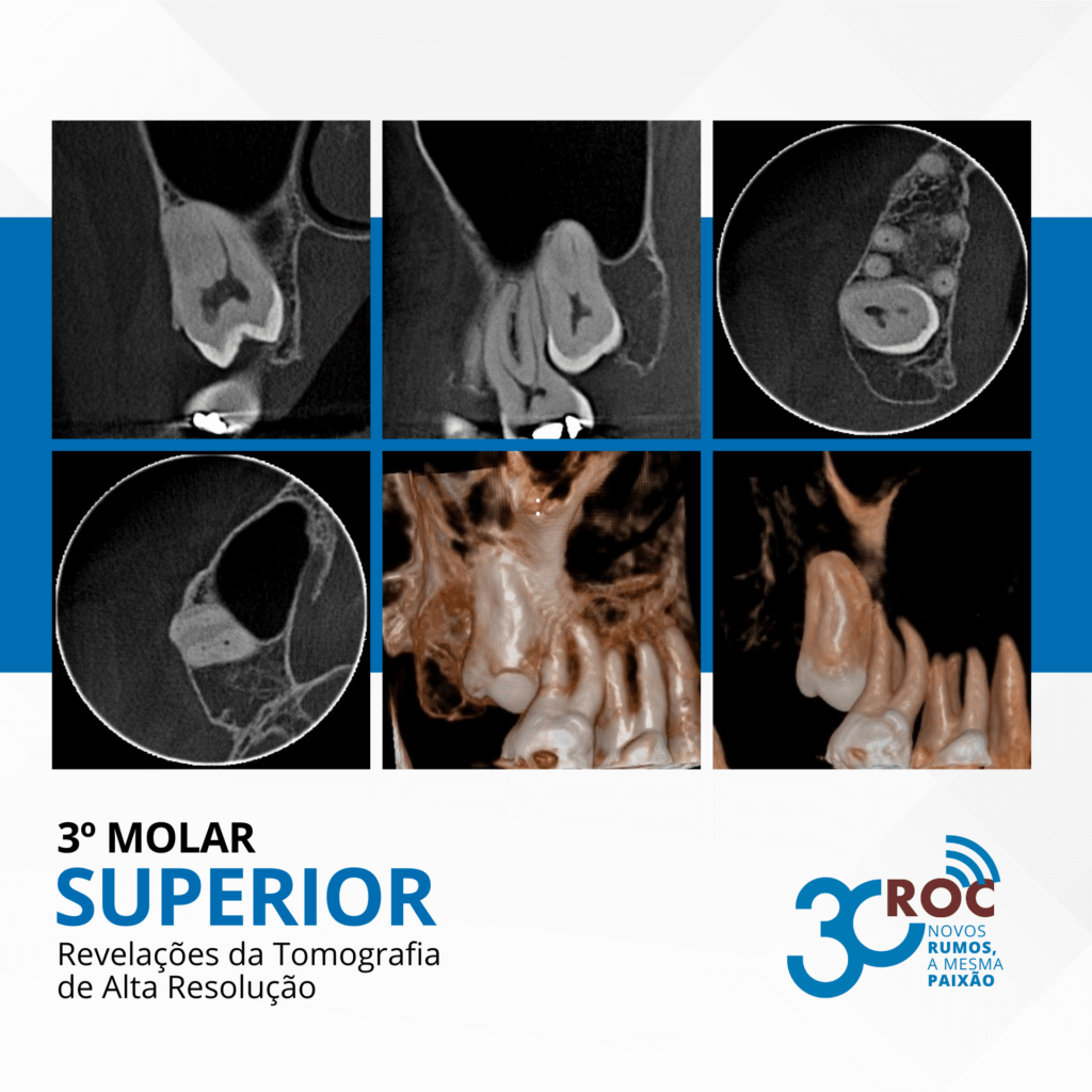 Terceiro molar superior: revelações da tomografia de alta resolução