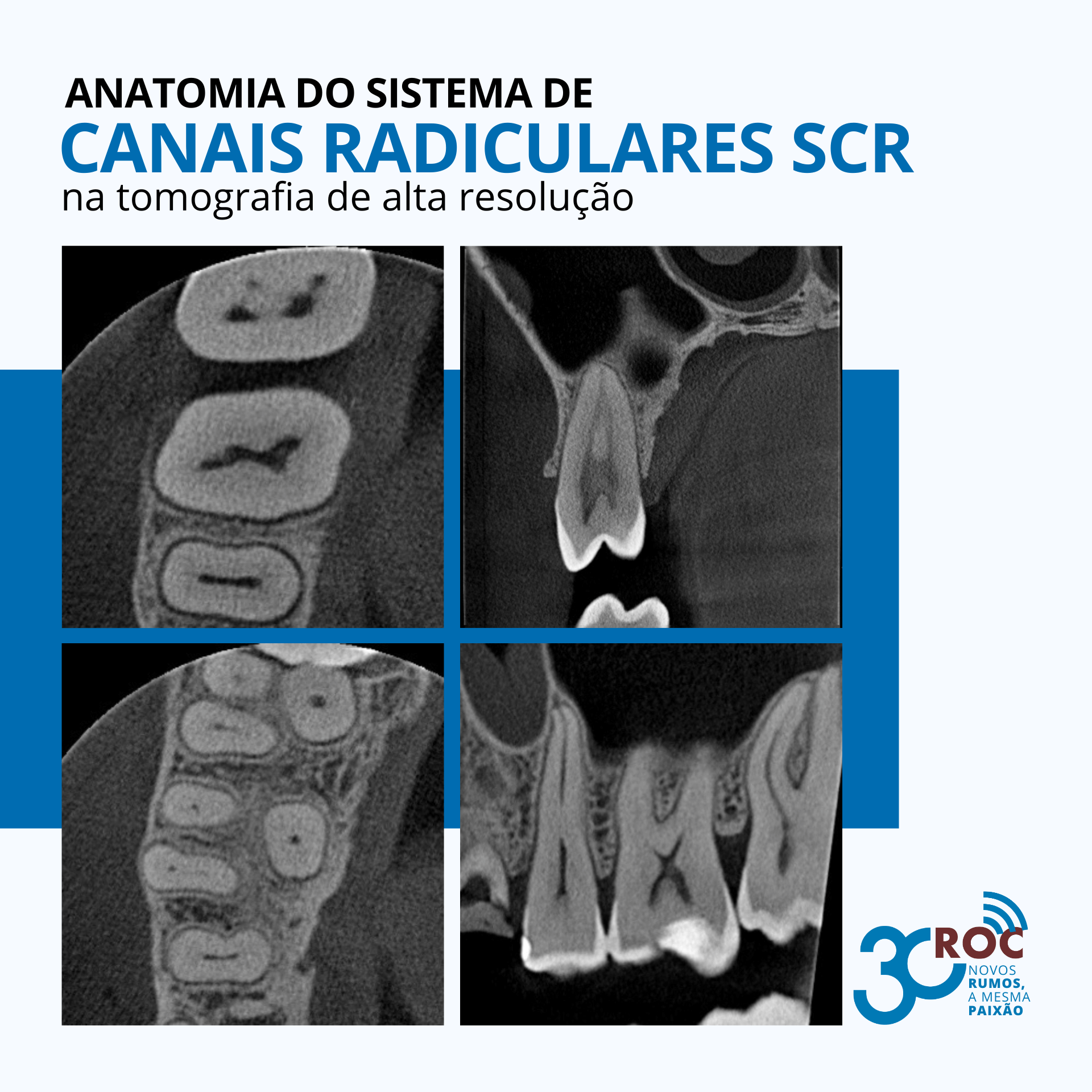 Anatomia do sistema de canais radiculares na tomografia de alta resoluÃ§Ã£o