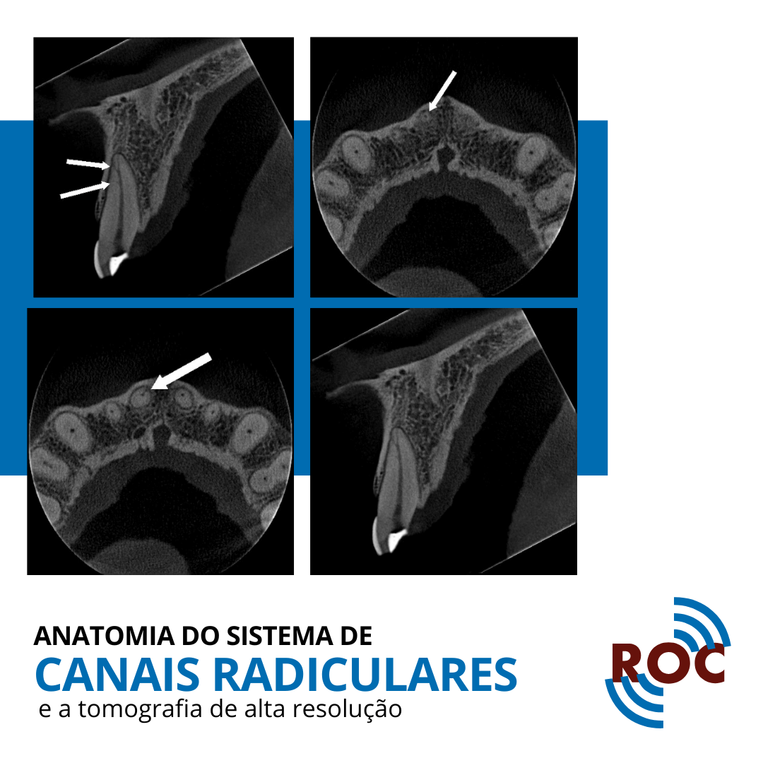 Anatomia do Sistema de Canais Radiculares