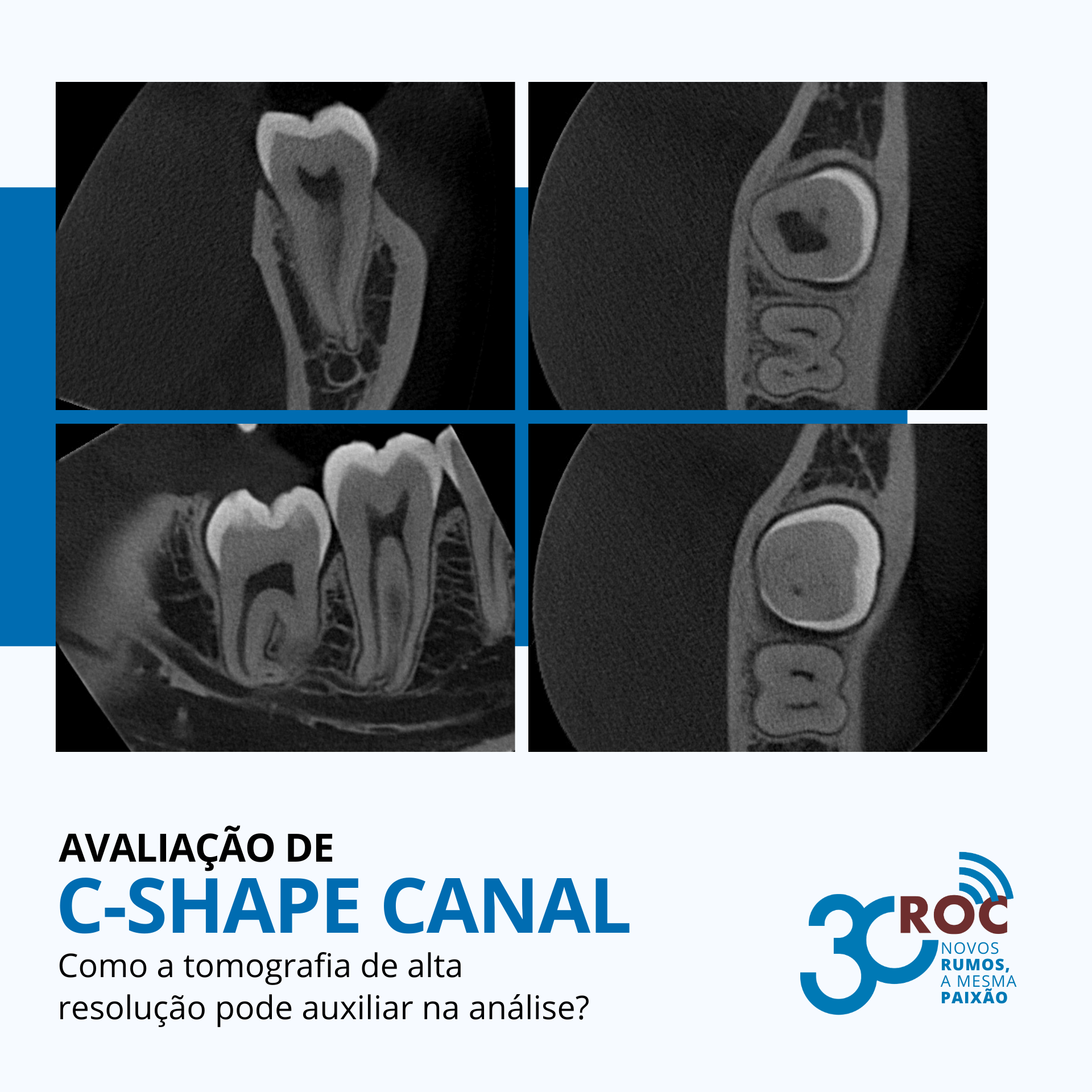 AvaliaÃ§Ã£o de canal em C: como a tomografia de alta resoluÃ§Ã£o auxilia na anÃ¡lise
