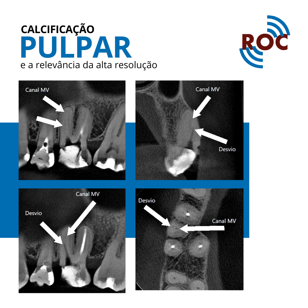 CalcificaÃ§Ã£o Pulpar e a RelevÃ¢ncia da Alta ResoluÃ§Ã£o