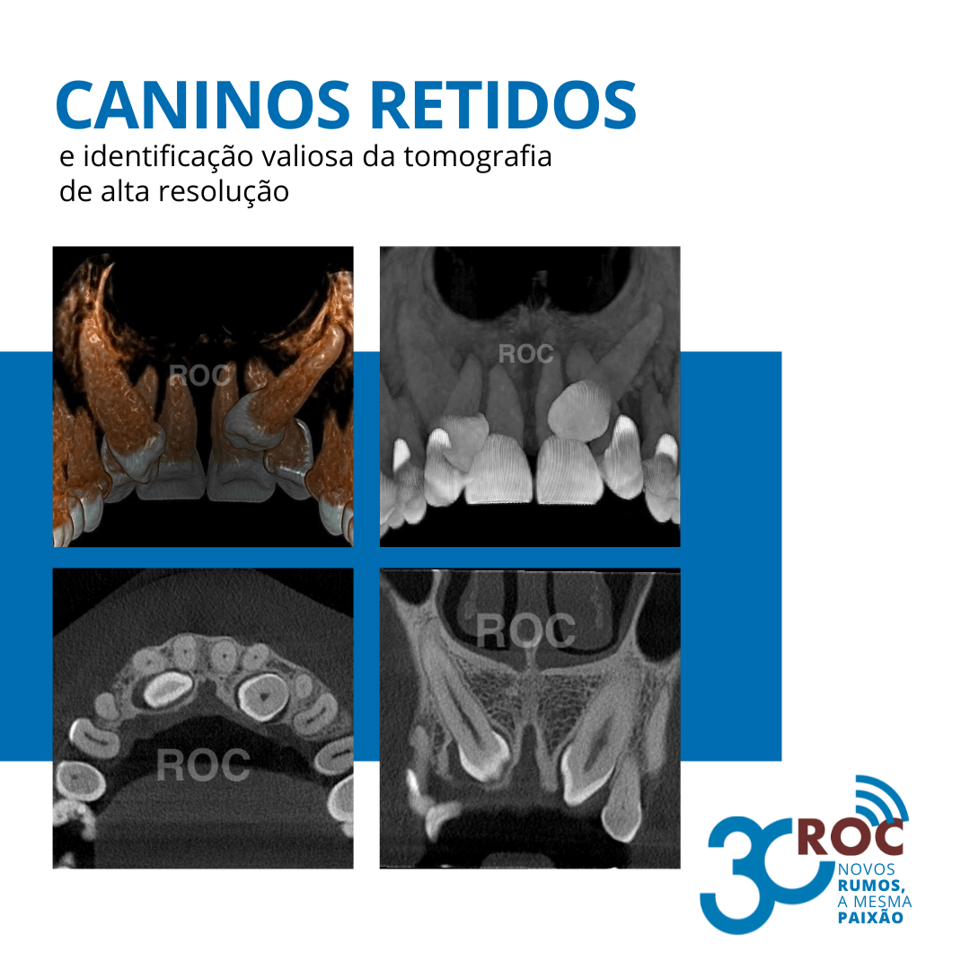 Caninos Retidos e a IdentificaÃ§Ã£o pela Tomografia de Alta ResoluÃ§Ã£o