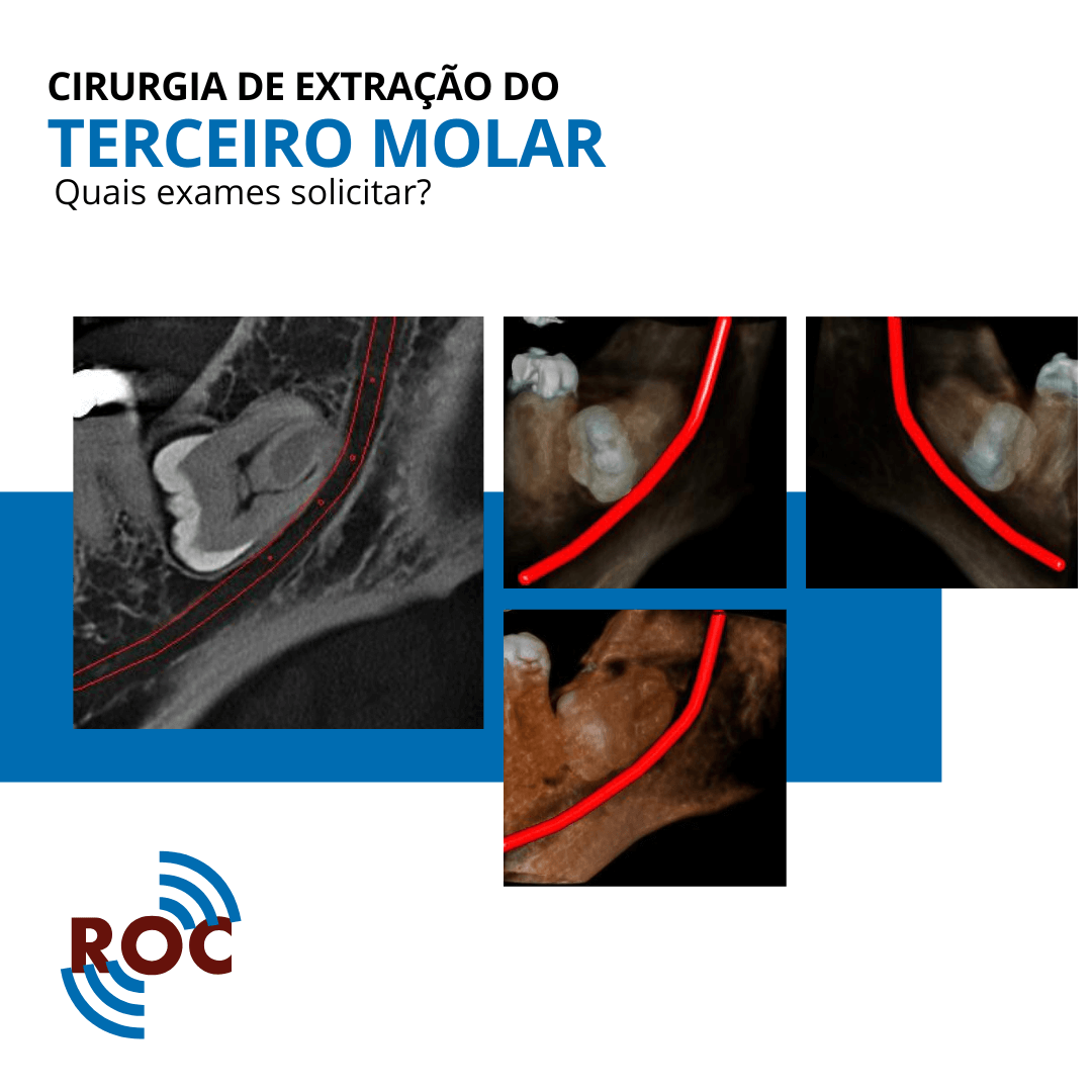 Cirurgia de ExtraÃ§Ã£o do Terceiro Molar