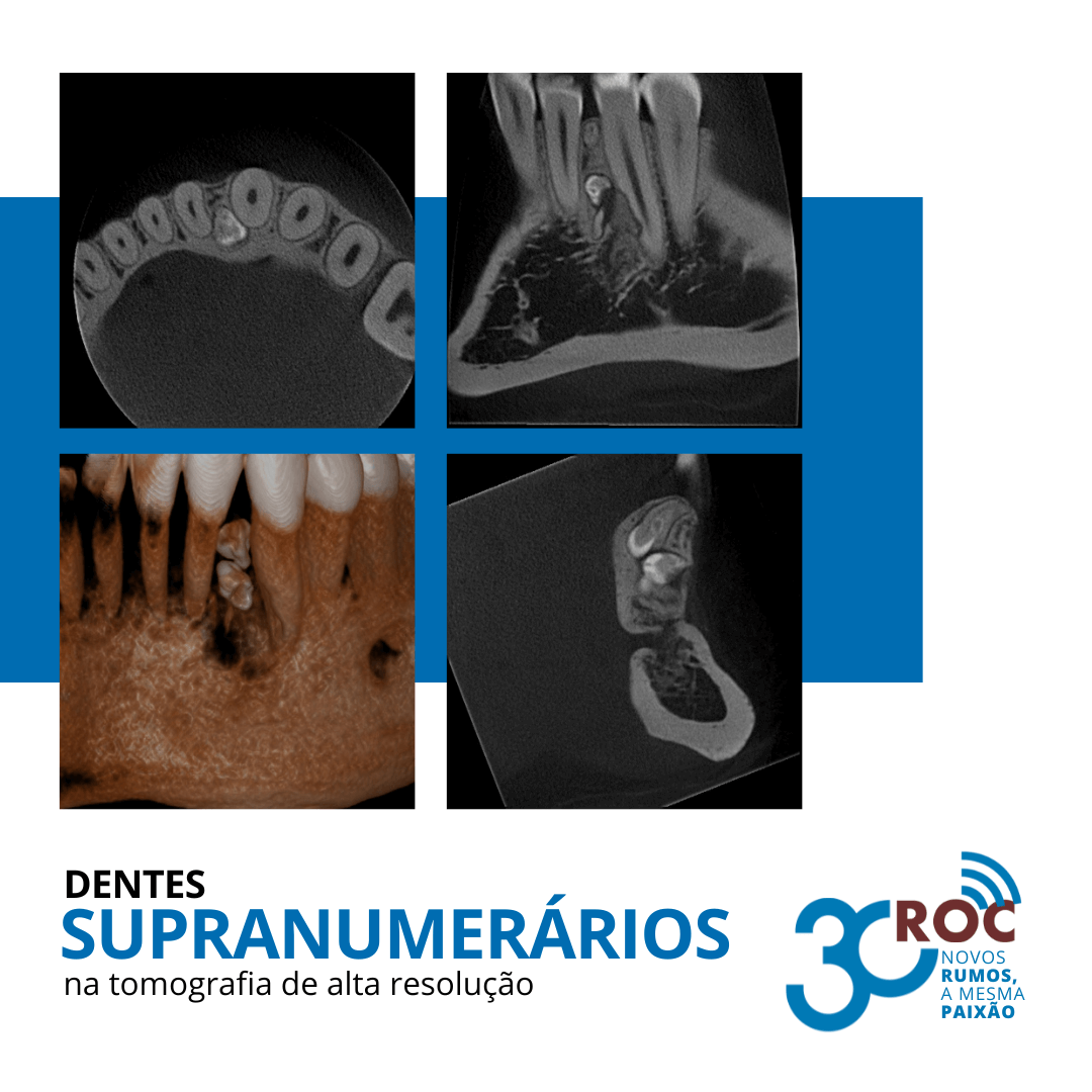 Dentes SupranumerÃ¡rios na Tomografia de Alta ResoluÃ§Ã£o