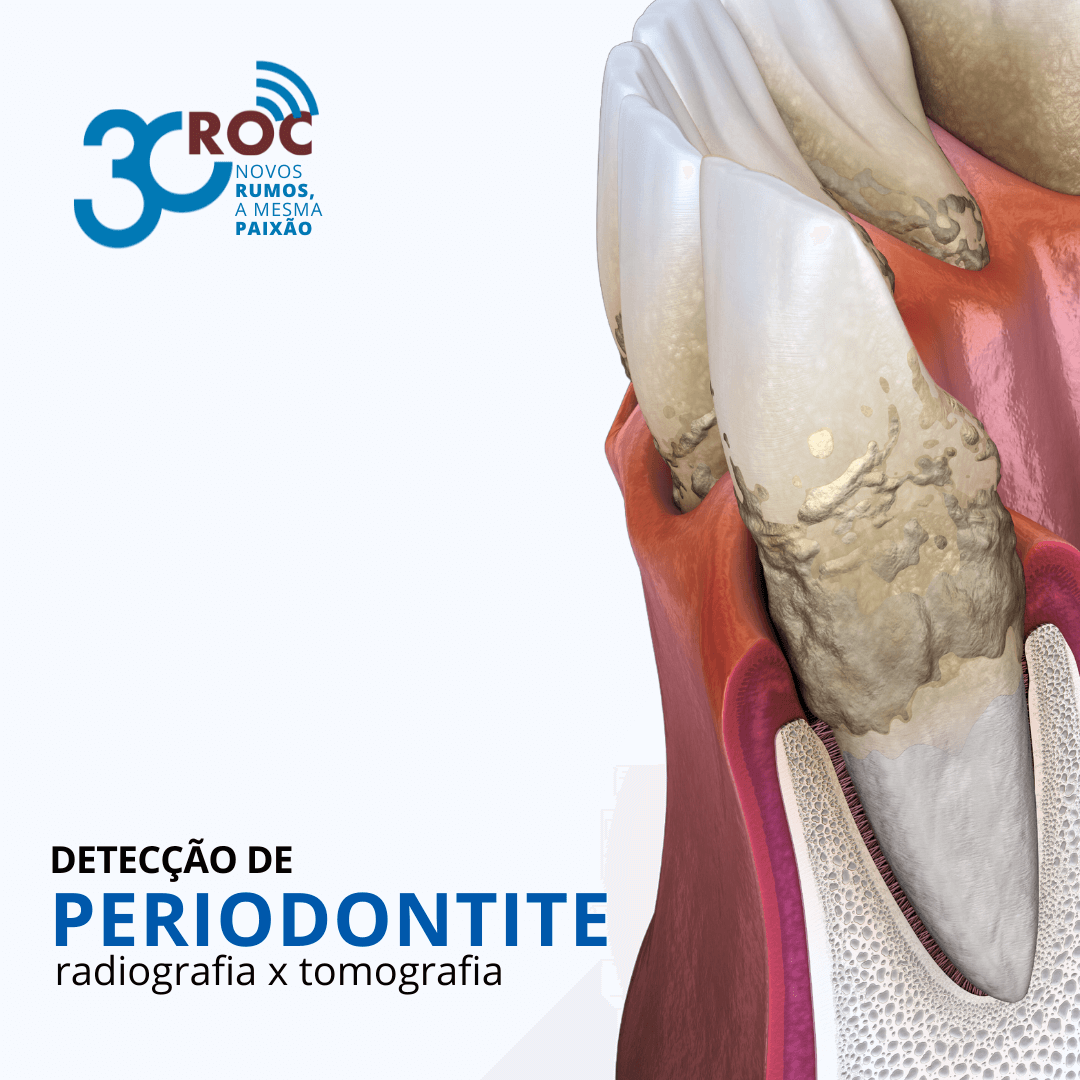 DetecÃ§Ã£o de Periodontite: Radiografia X Tomografia