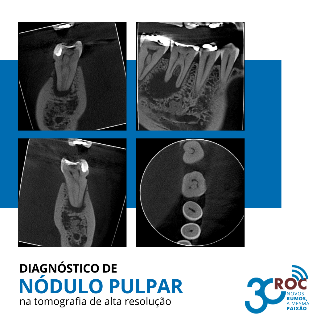 DiagnÃ³stico de NÃ³dulo Pulpar na Tomografia