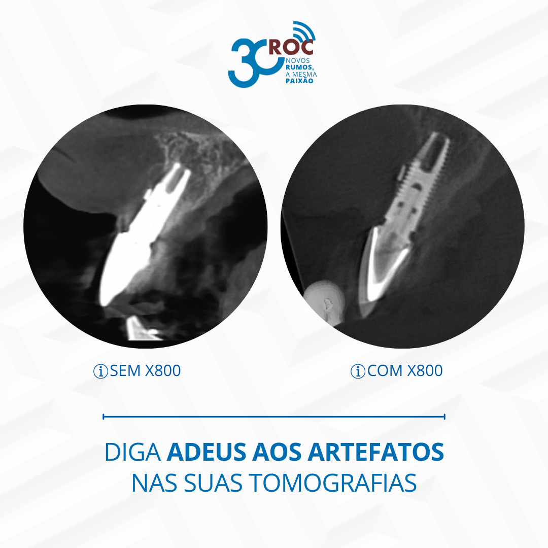 Diga Adeus aos Artefatos nas Suas Tomografias