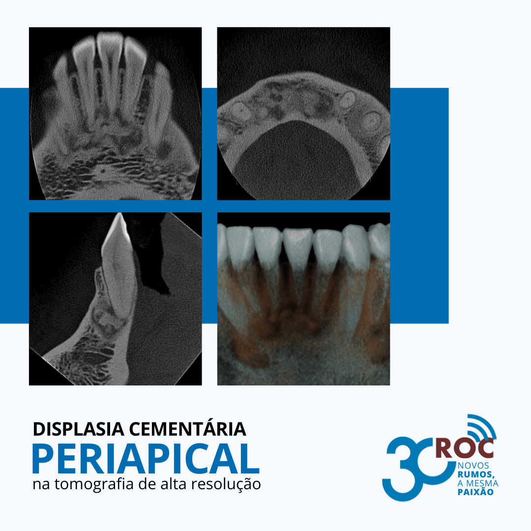 Displasia CementÃ¡ria Periapical