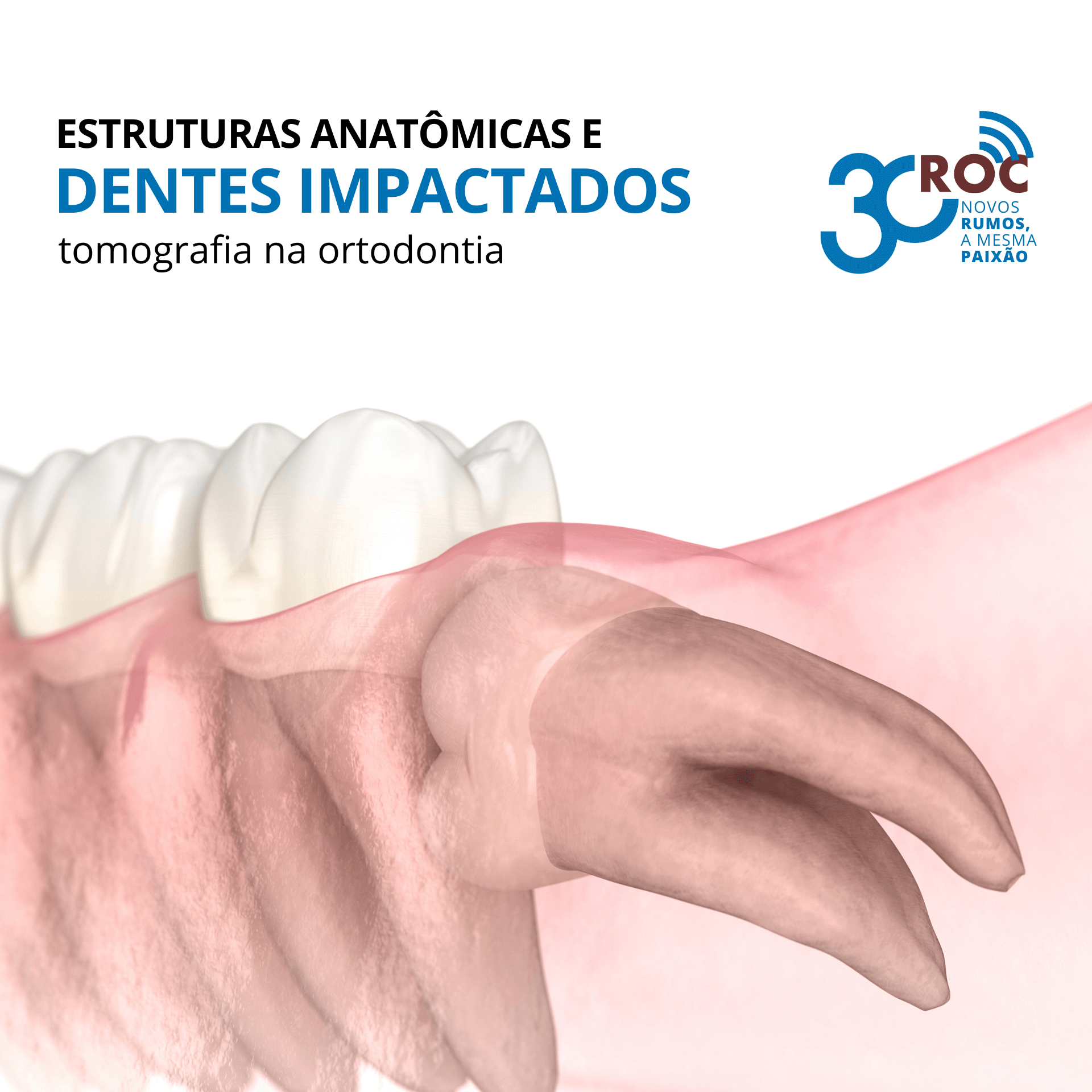 Estruturas anatÃ´micas e dentes impactados: a tomografia na ortodontia
