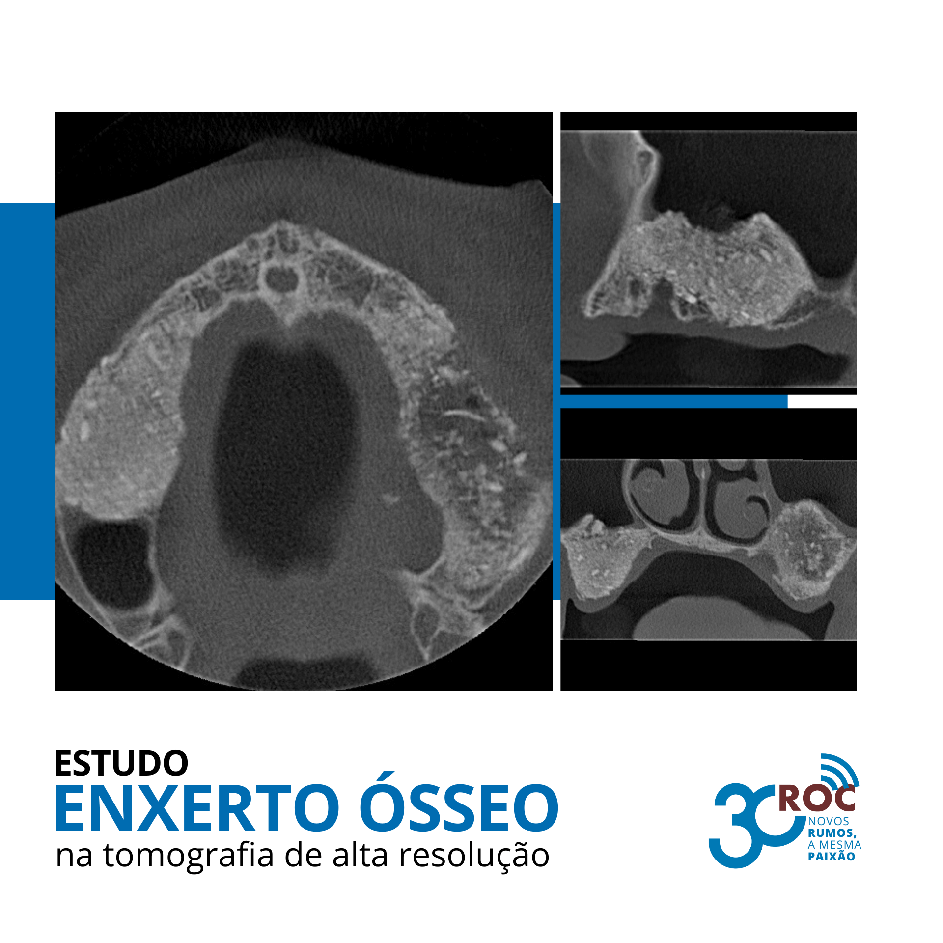Estudo de Enxerto Ã“sseo na Tomografia de Alta ResoluÃ§Ã£o