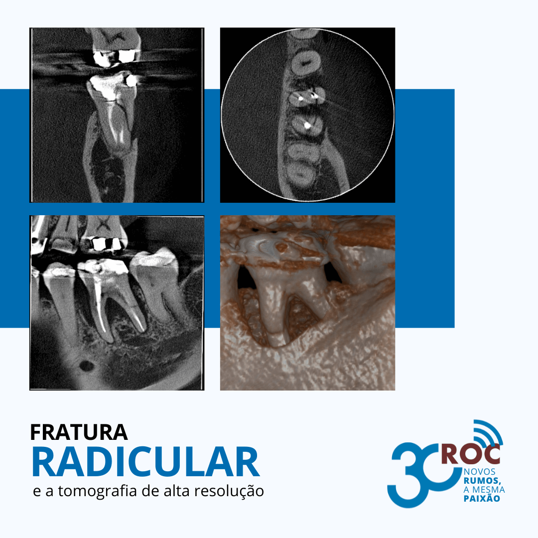 Fratura Radicular e a Tomografia de Alta ResoluÃ§Ã£o