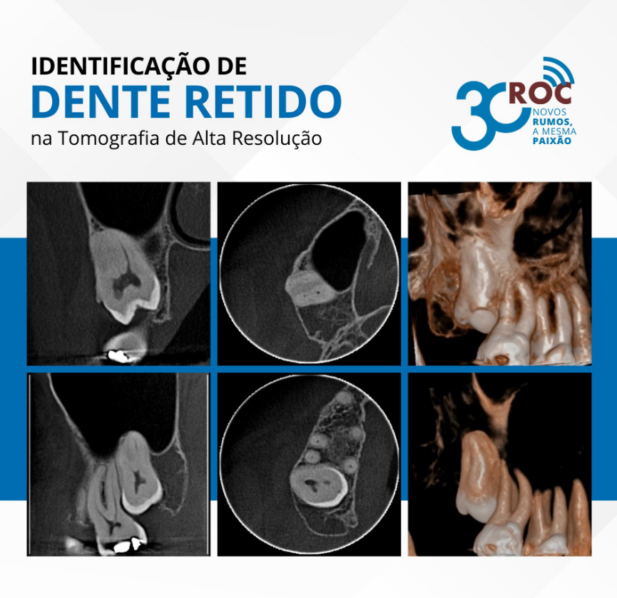 IdentificaÃ§Ã£o de dente retido com tomografia de alta resoluÃ§Ã£o