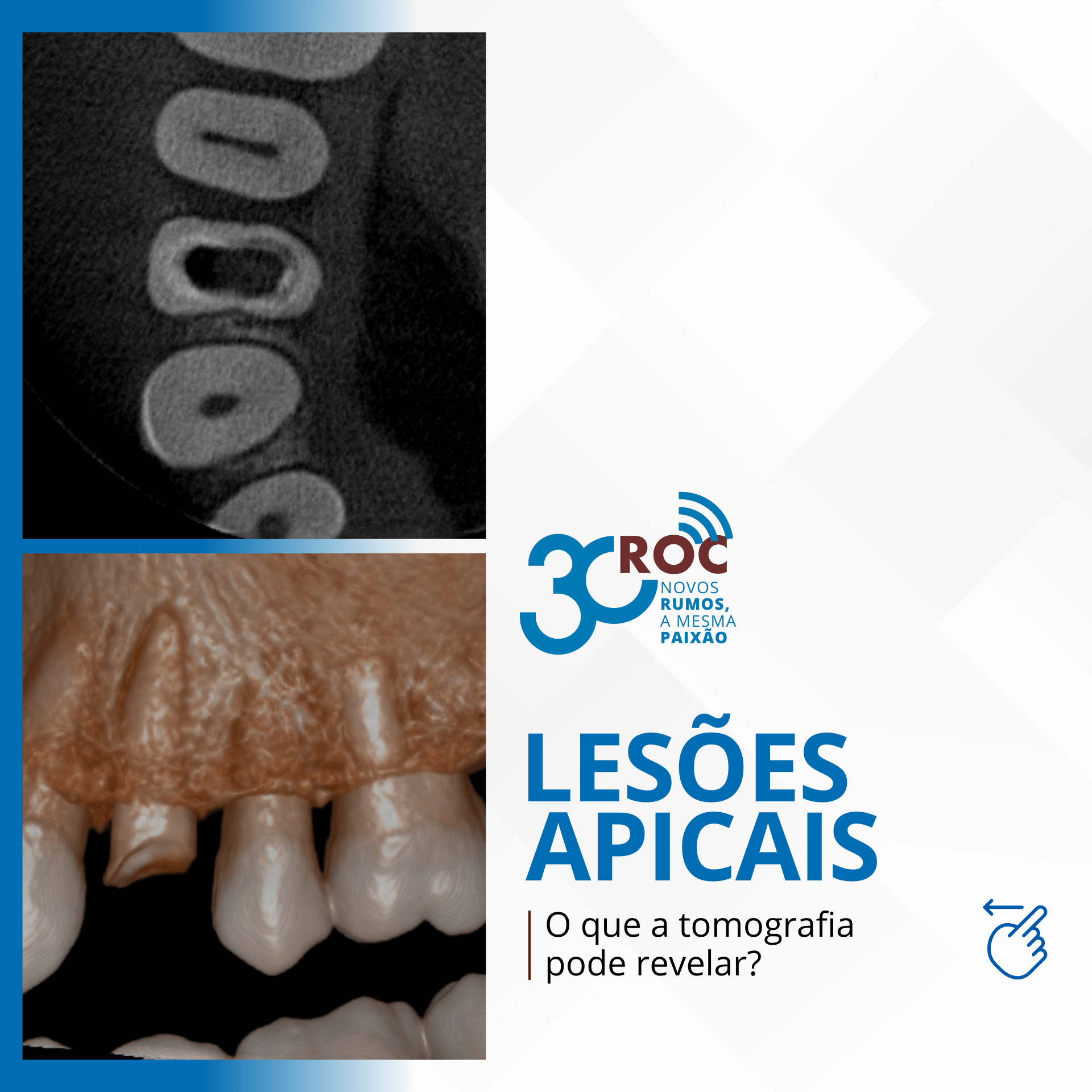 LesÃµes apicais: o que a tomografia pode revelar?