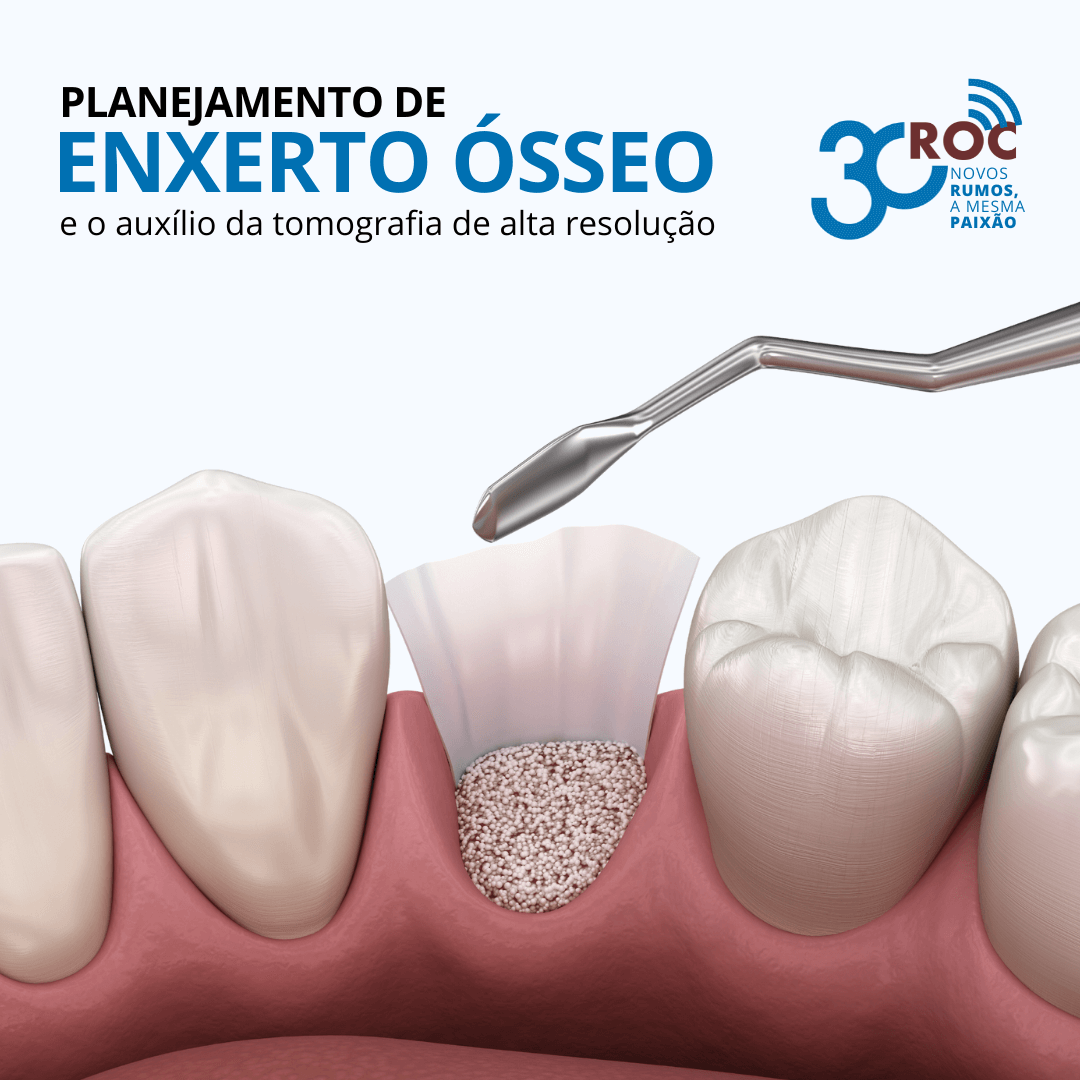 Planejamento de Enxerto Ã“sseo