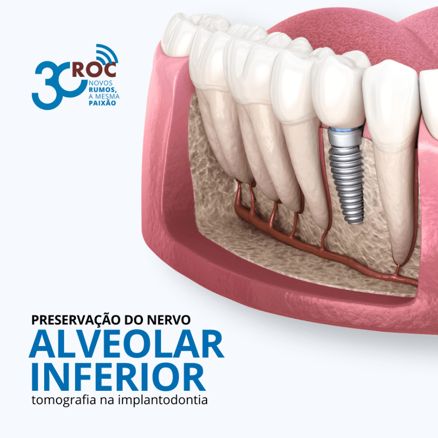 PreservaÃ§Ã£o do nervo alveolar inferior no planejamento de implantes