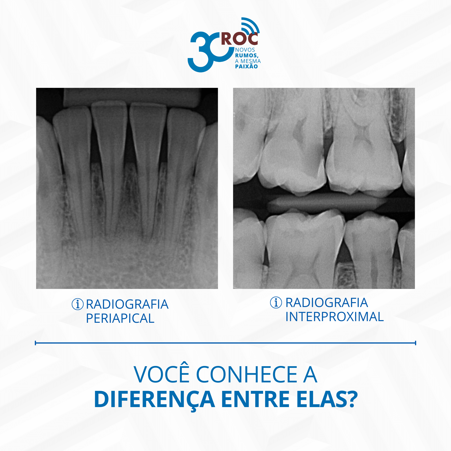 Radiografia periapical x interproximal: vocÃª conhece a diferenÃ§a?