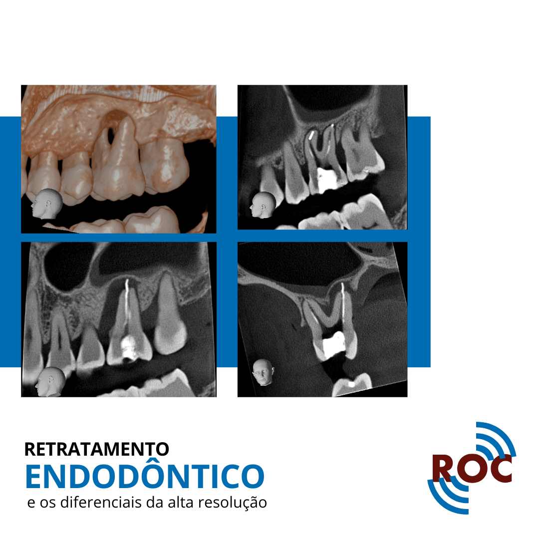Retratamento EndodÃ´ntico