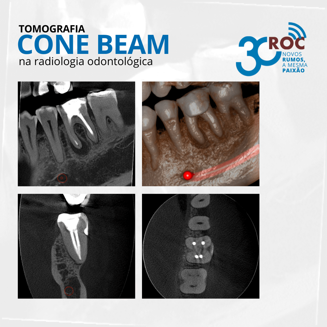 Tomografia Cone Beam na Radiologia OdontolÃ³gica