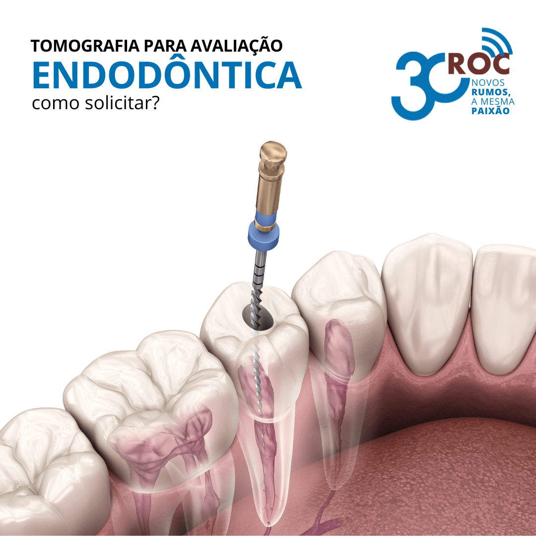 Tomografia para AvaliaÃ§Ã£o EndodÃ´ntica