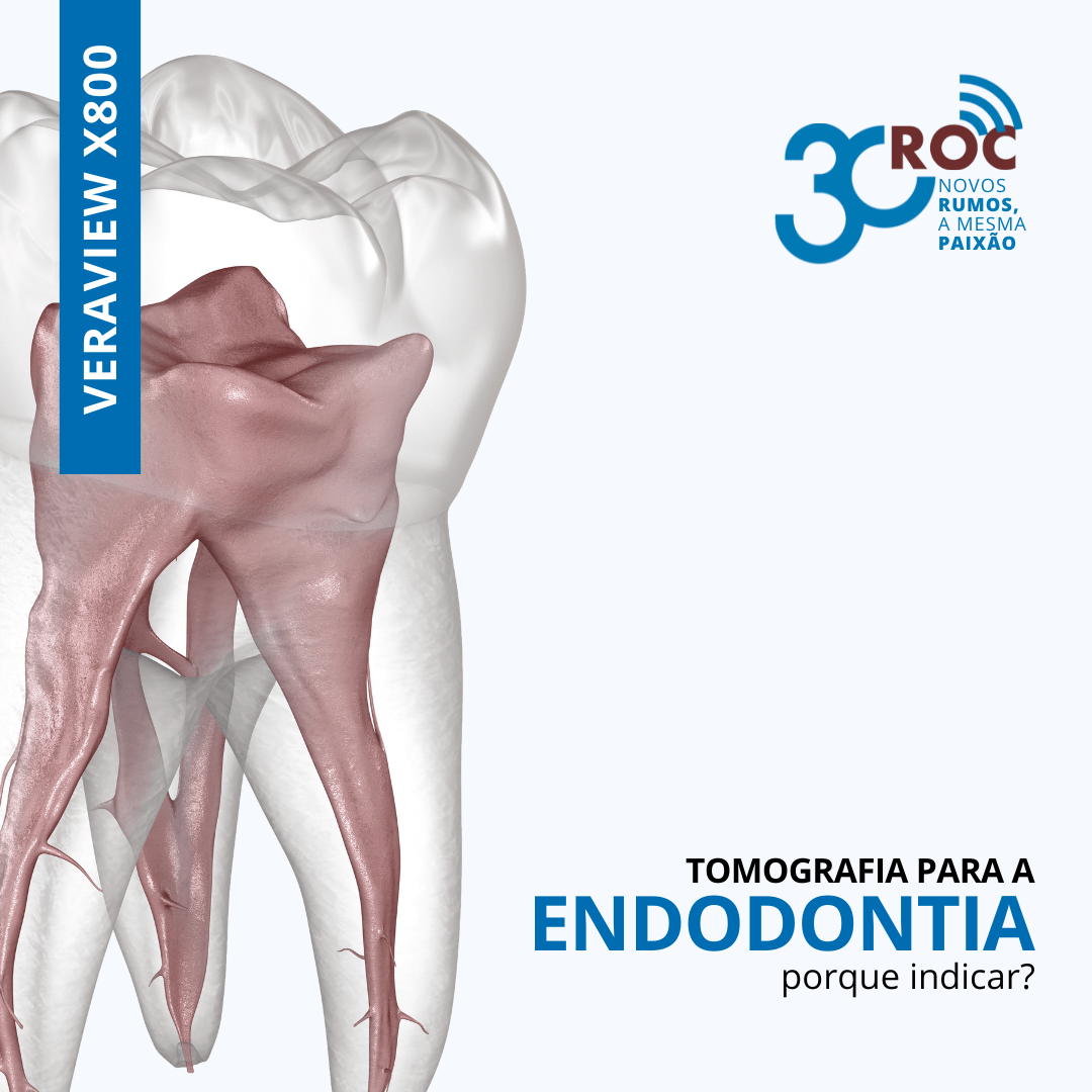 Tomografia para Endodontia: Por Que Solicitar?