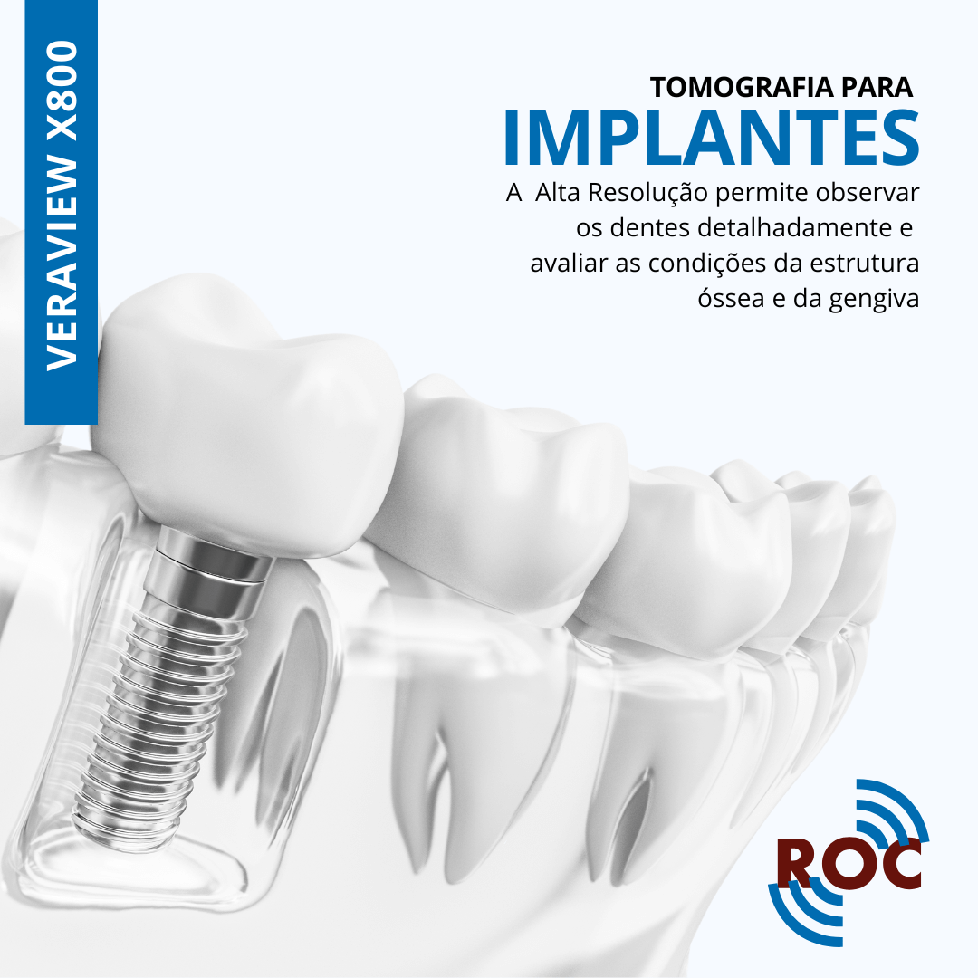 Tomografia para Implantes